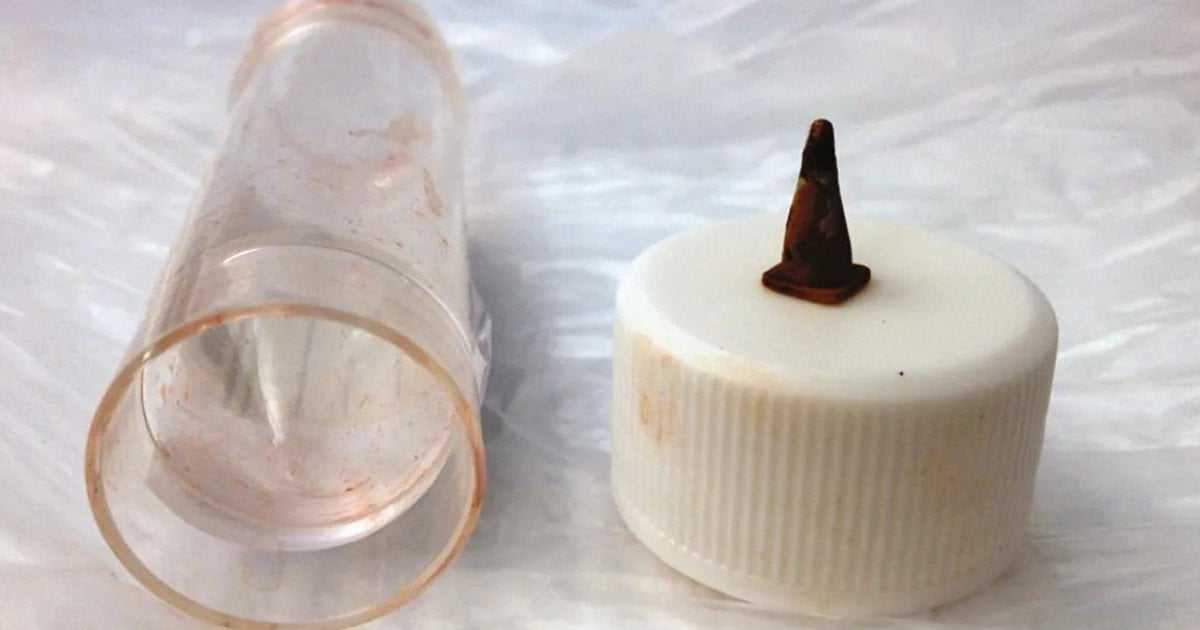 Іграшковий дорожній конус в легені пацієнта. Фото: Lammy et al., JRSM Open 2013 (CC BY-NC 2.0)