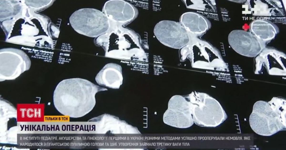 В Украине впервые удалили гигантскую опухоль у младенца, которая была вдвое больше его головы