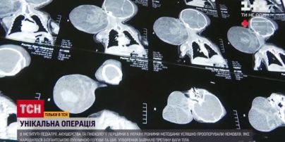 В Украине впервые удалили гигантскую опухоль у младенца, которая была вдвое больше его головы