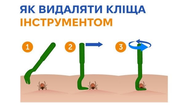 Видалення кліща спеціальним інструментом / © Центр громадського здоров’я МОЗ України