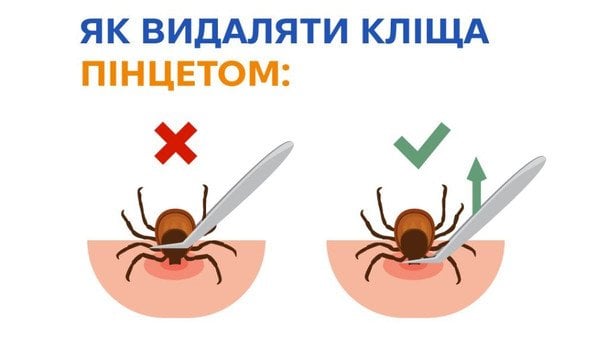 Видалення кліща пінцетом / © Центр громадського здоров’я МОЗ України