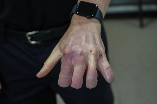 Рука Ентоні / © SWNS