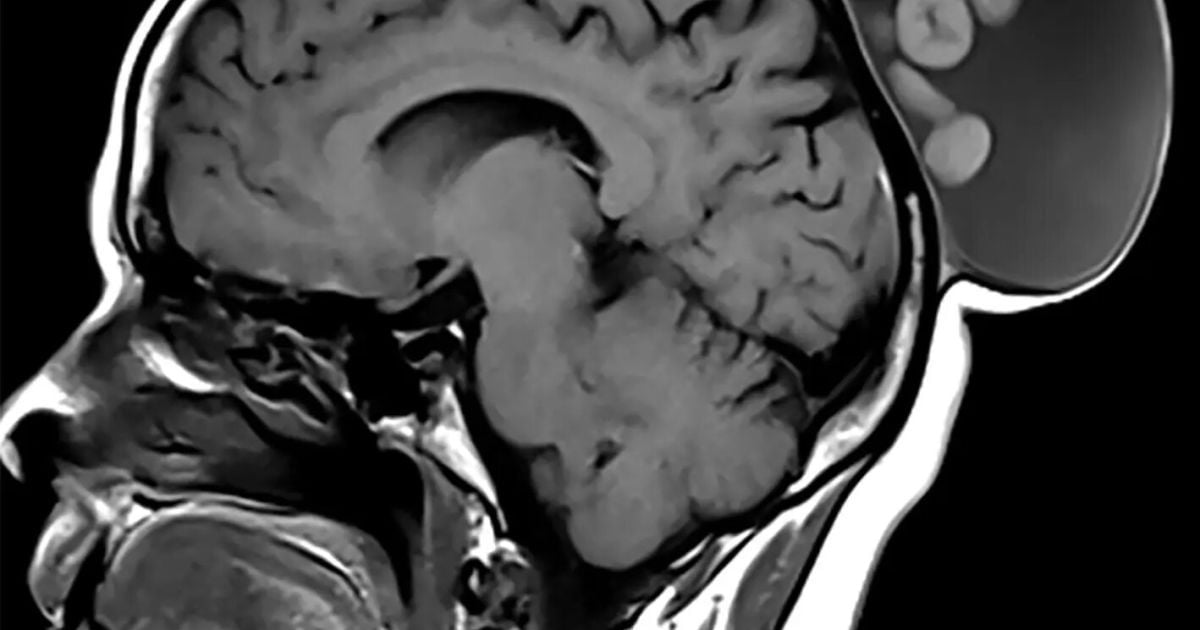 Женщине удалили большую опухоль с кистами / Фото: RSNA