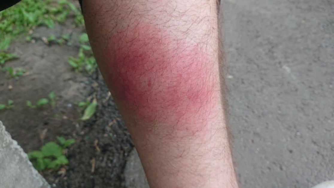 Аллергия на укусы насекомых: симптомы, первая помощь, способы защиты