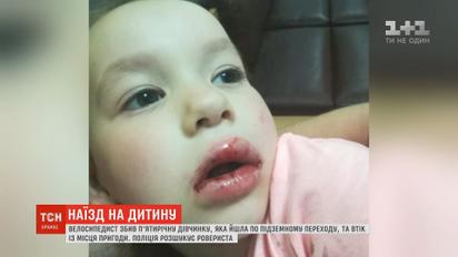 Многочисленные ушибы и выбитые зубы: в Киеве велосипедист сбил девочку и скрылся