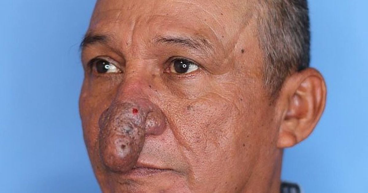 Выглядел как пенис и портил жизнь: художнику из США укоротили нос