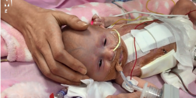 У Британії лікарі врятували немовля, котре народилося із серцем назовні 
