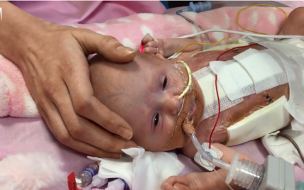 У Британії лікарі врятували немовля, котре народилося із серцем назовні 
