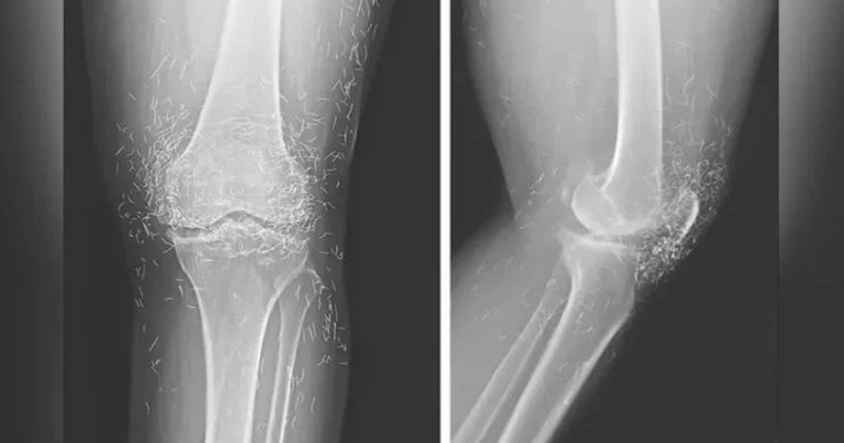 Золото в теле женщины / Фото: The New England Journal of Medicine