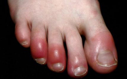 "Ковидные" пальцы: пациенты жалуются на воспаление и покраснение, симптом напоминает обморожение