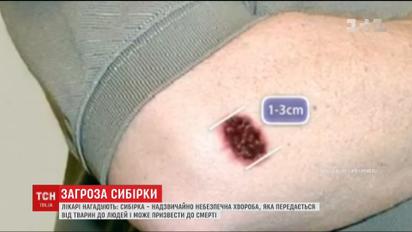 Лікарі нагадують про небезпеку та легкість зараження сибірською виразкою
