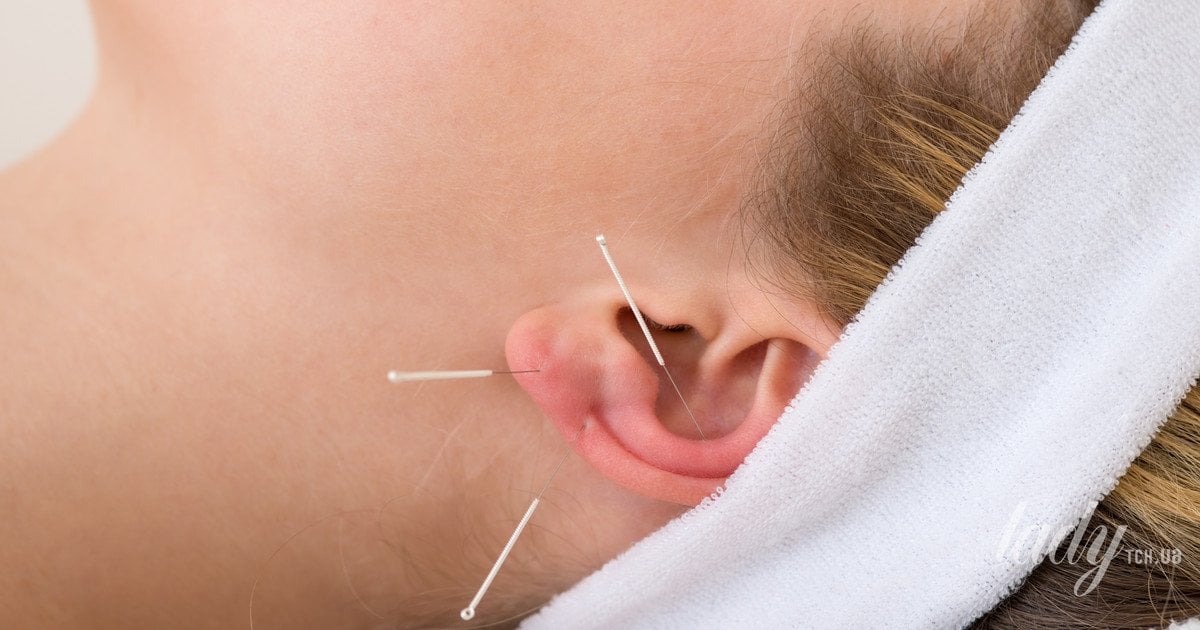 Акупунктура