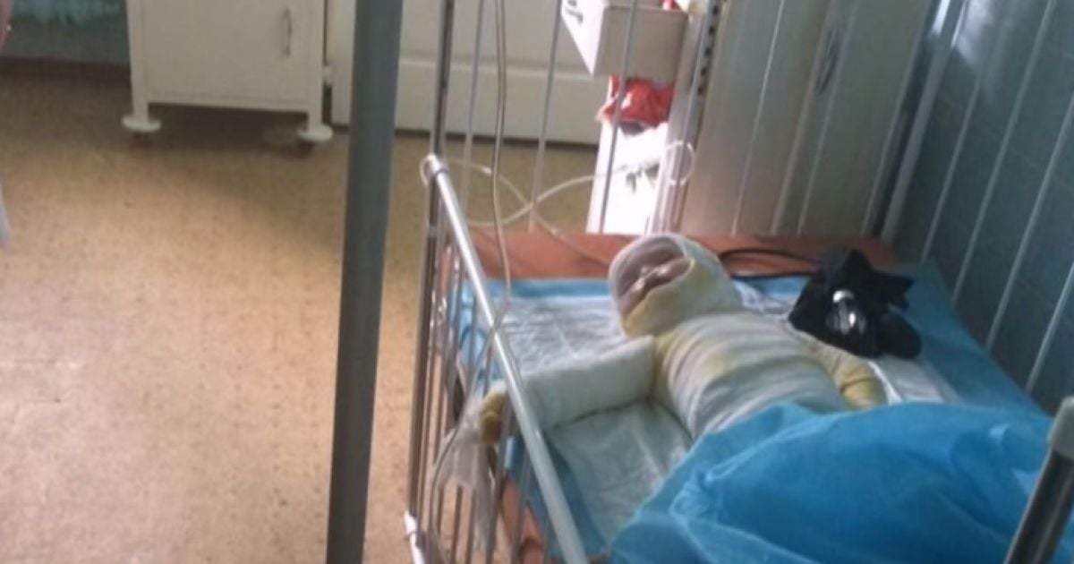 В Одессе умерла 2-летняя девочка, которую родители обварили кипятком и две недели сами лечили