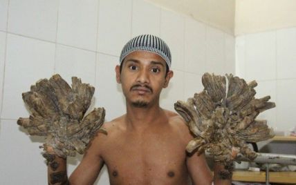 В Бангладеш врачи провели уникальную операцию "Человеку-дереву"