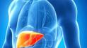 Як врятувати свою печінку від неалкогольної жирової хвороби