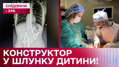 Лікарі в шоці! Хлопчик проковтнув 20 магнітів! В якому стані дитина?