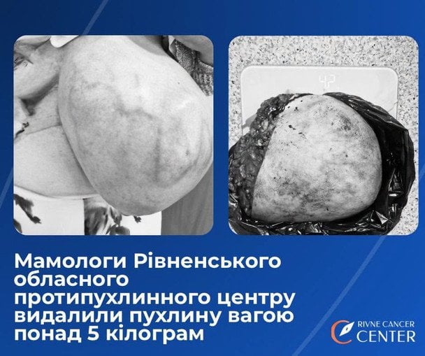 Вирізана пухлина / © Рівненський обласний протипухлинний центр