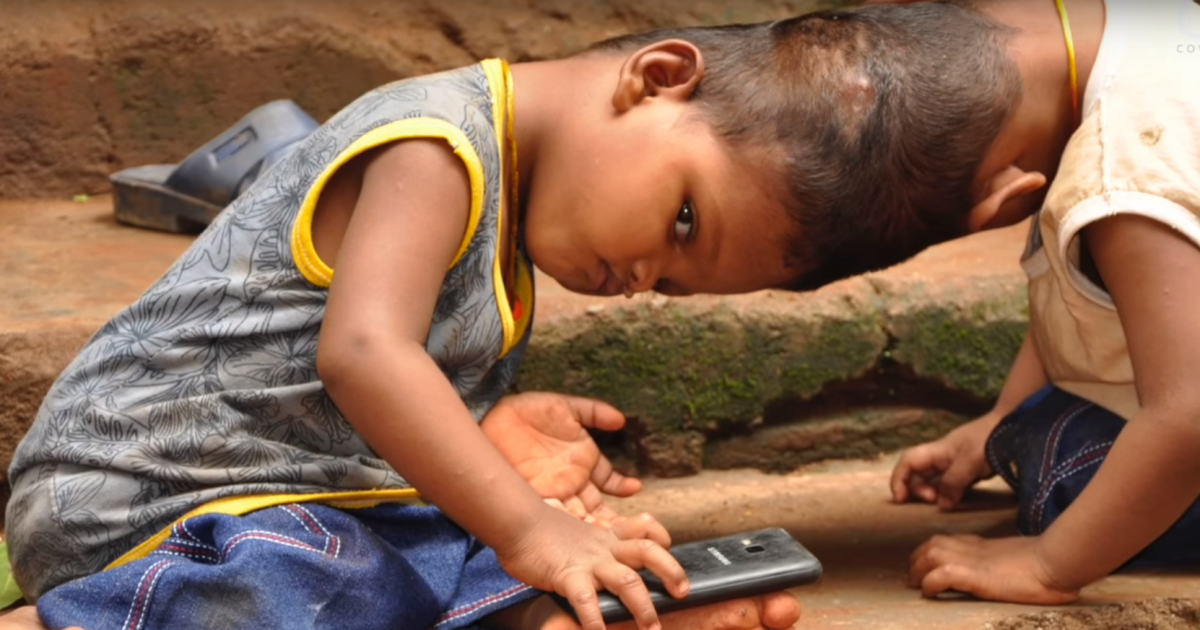 В Индии врачи разделят слитых головами близнецов