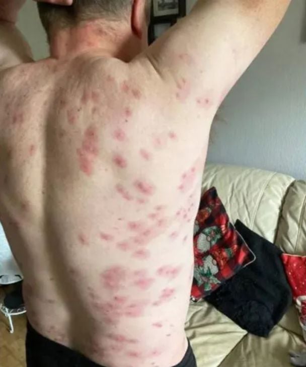 Тіло чоловіка після нападу ос / Фото: Andrew Powell