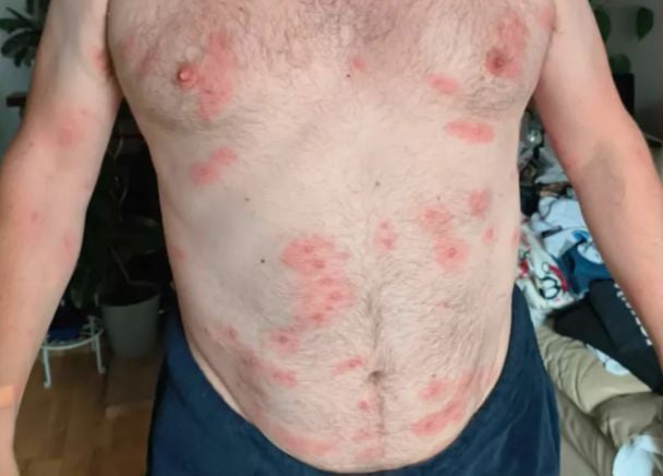 Тіло чоловіка після нападу ос / Фото: Andrew Powell