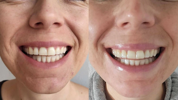 Результат полоскання ротової порожнини оливковою олією / © Фото з соціальних мереж