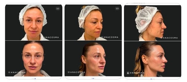 Ольга Мартыновская — до (сверху) и после (ниже) интенсивных косметологических процедур