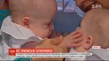 У Хорватії лікарі успішно розділили сіамських близнюків