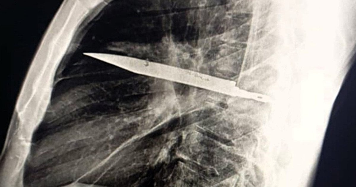 Ніж у грудях пацієнта