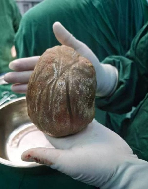 У 56-річного чоловіка видалили гігантський камінь у сечовому міхурі вагою 1,3 кг — фото