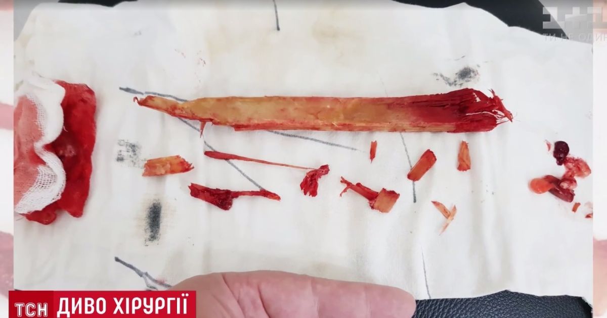 Диво медицини: хірурги Інституту Шалімова дістали з шиї пацієнта 25-сантиметровий кілок