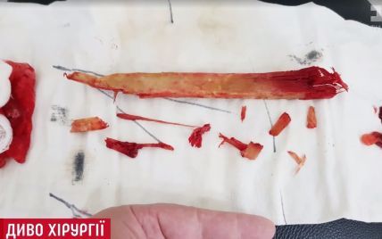 Чудо медицины: хирурги Института Шалимова достали из шеи пациента 25-сантиметровый кол