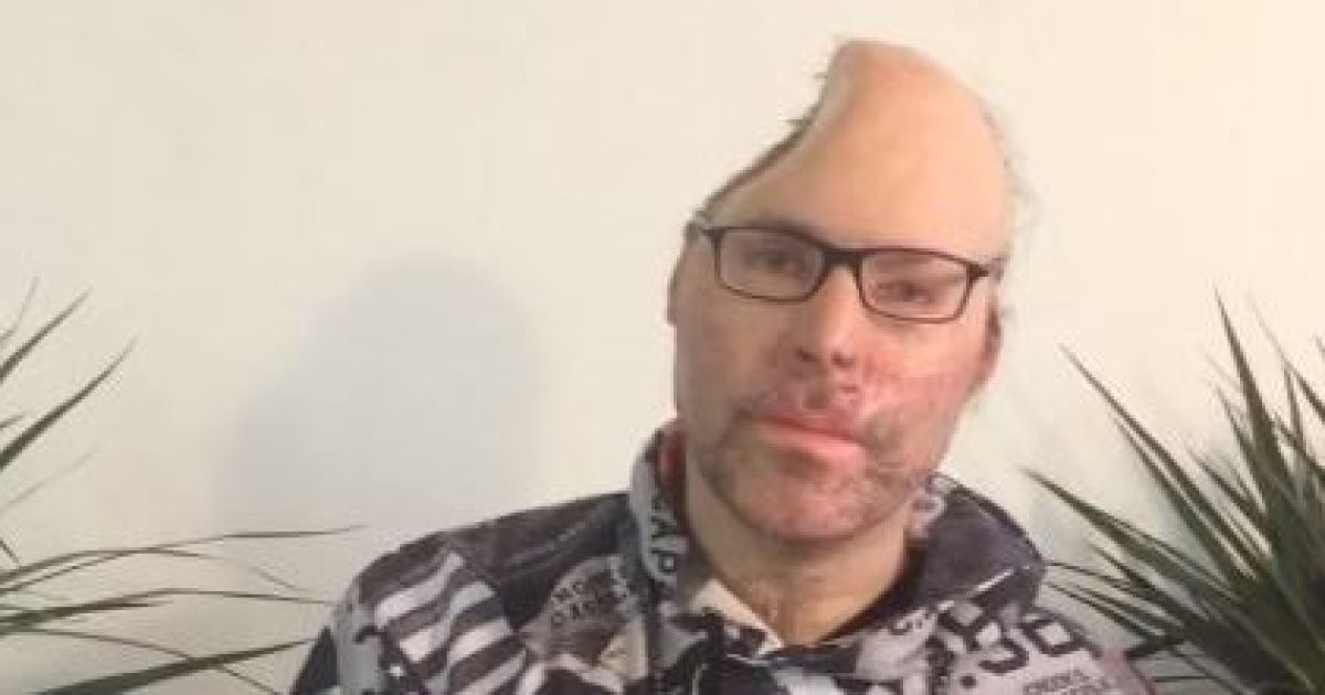 Немецкий рэпер Dr. Knarf после взрыва в его нарколаборатории потерял половину черепа