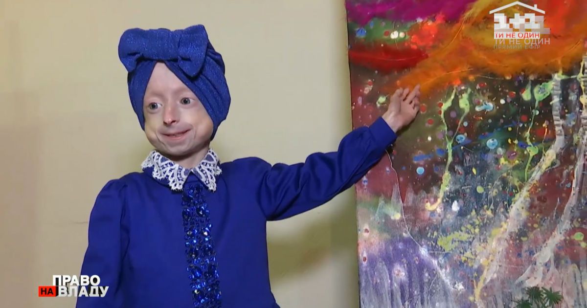 Умерла Ира Химич с синдромом преждевременного старения — Украина — tsn.ua