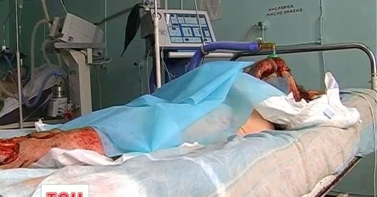Власниця собаки може втратити обидві руки