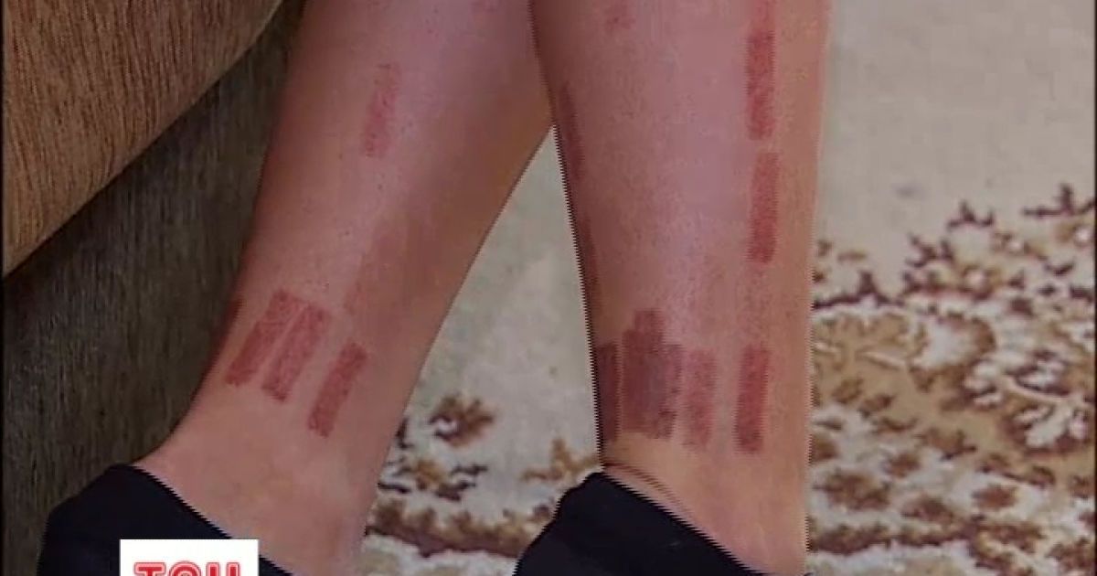 Жінці із опіками навіть не викликали "швидку"