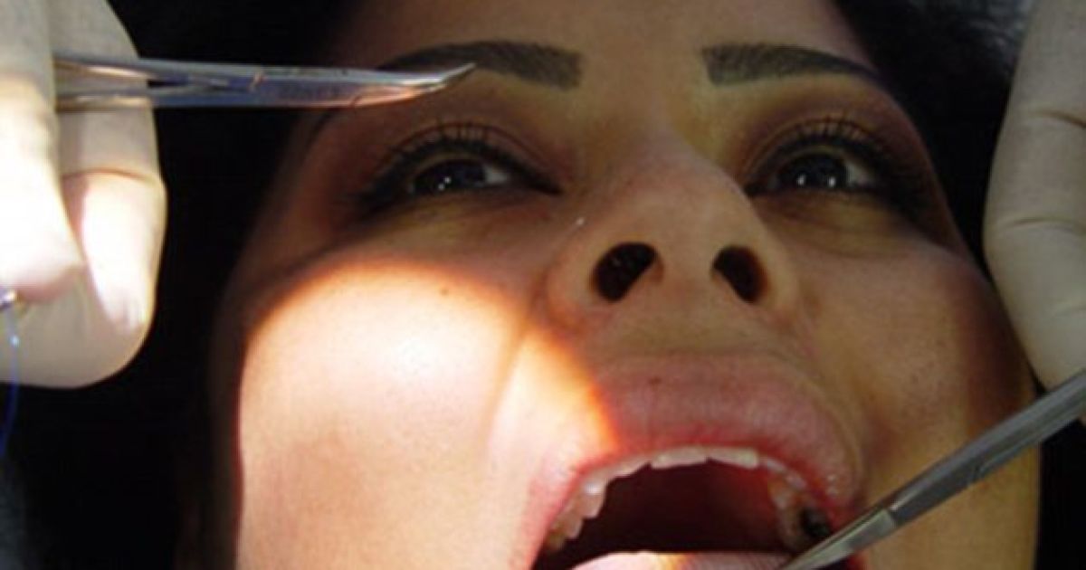 Охочим схуднути пришивають до язика латку, яка заважає їсти.