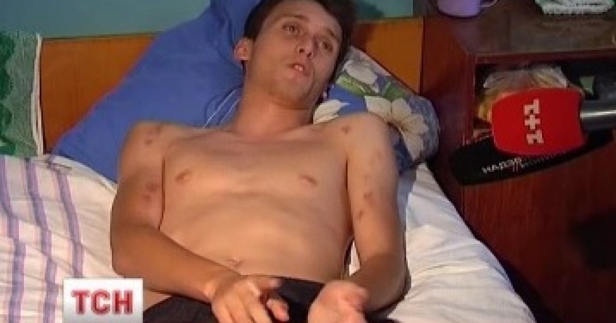 У хлопця діагностували численні побої