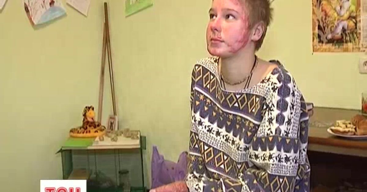 Найбільше у Христини обгоріли обличчя та руки
