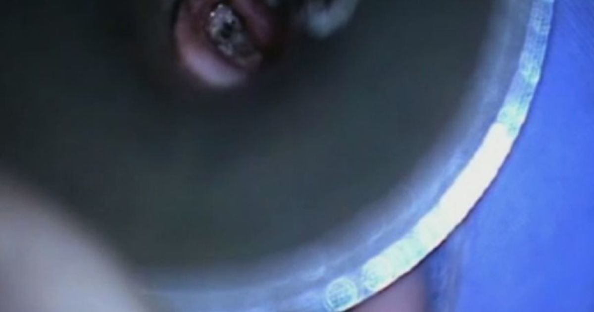 У вусі дівчини знайшли кубло м'ясоїдних личинок.