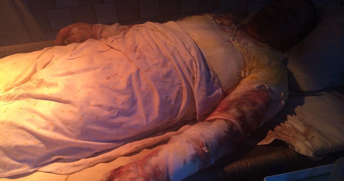 Поранений боєць АТО