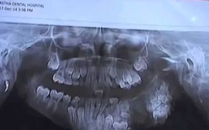 В Индии семилетнему мальчику удалили 80 зубов