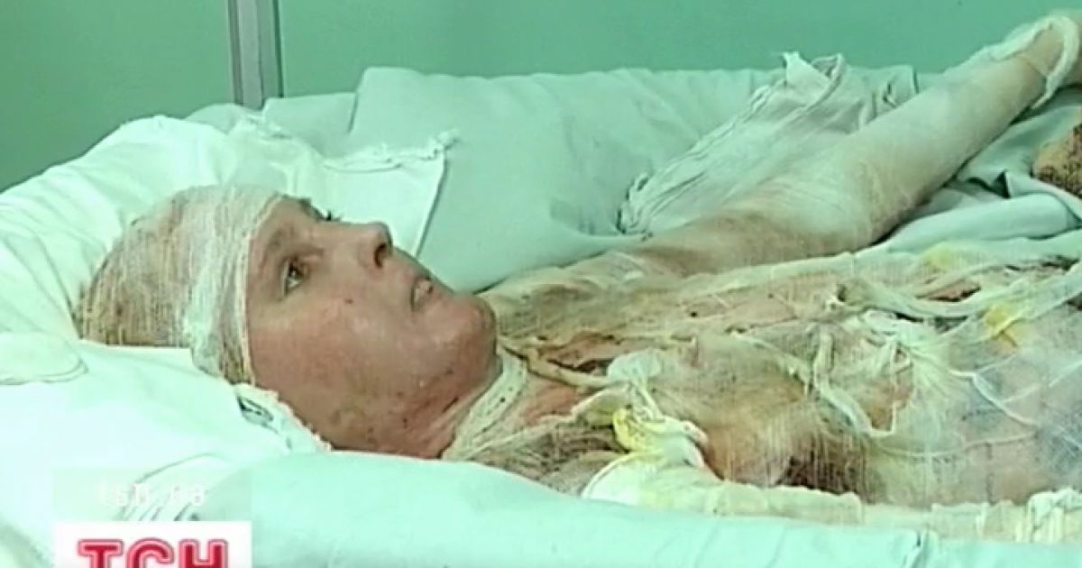 Лікарі врятували жінку, у якої майже 100% опіків тіла