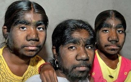 В Індії знайшли унікальну родину сестер-"перевертнів" (фото)