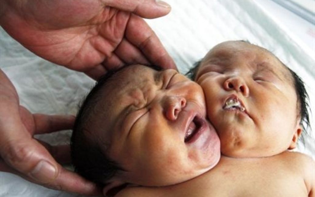Унікальні сіамські близнюки народились у китайському місті Суйнін, провінція Сичуань. / © AFP