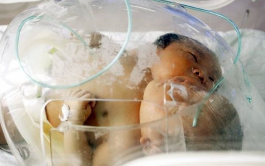 Лікарі вважають розділення дітей практично неможливим. / © AFP