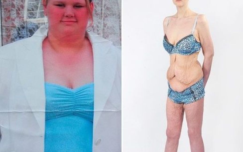 Малісса Джонс до і після резекції шлунка / © mirror.co.uk