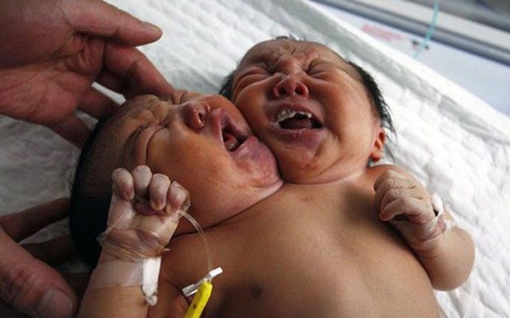 Китай, Суйнін. Лікарі опікуються новонародженими з&#039;єднаними дівчатками-близнюками у лікарні міста Суйнін. Сіамські близнюки народилися з одним тілом і двома головами, дівчата важать 4,05 кг і мають зріст 50 см. / © AFP