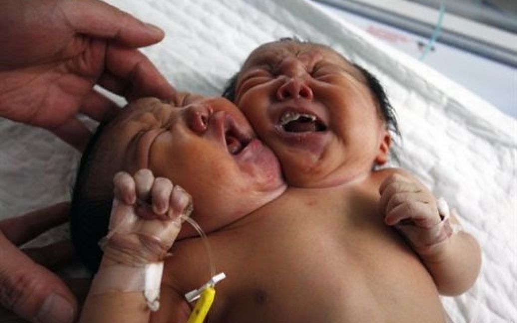 В Китаї народились сіамські близнюки з двома головами / © AFP