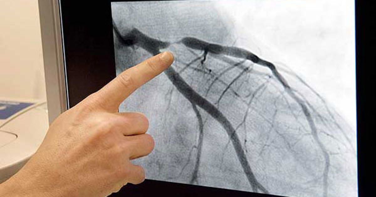 Ірландець зняв на фотокамеру операцію на власному серці, відмовившися від загального наркозу. / © swns.com