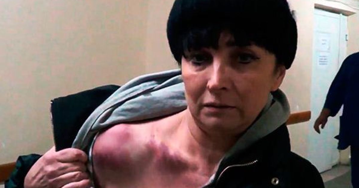 Журналістка показала свої синці та забої